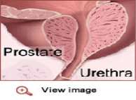 آزمایش پی اس آ  PSA Test و تشخیص سرطان پروستات